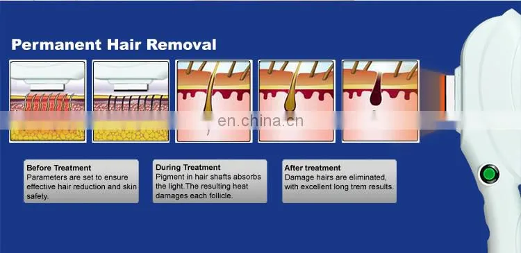 2 in 1 ipl laser hair removal machine prices/laser ipl+biopolar radio frequency skin rejuvenation