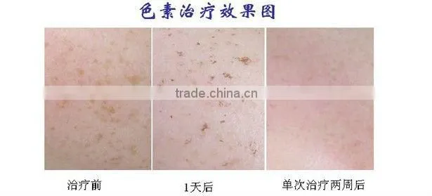 2013 Pixel Co2 Fractional Laser 30w/ Medical Laser Equipment --- Co2laser