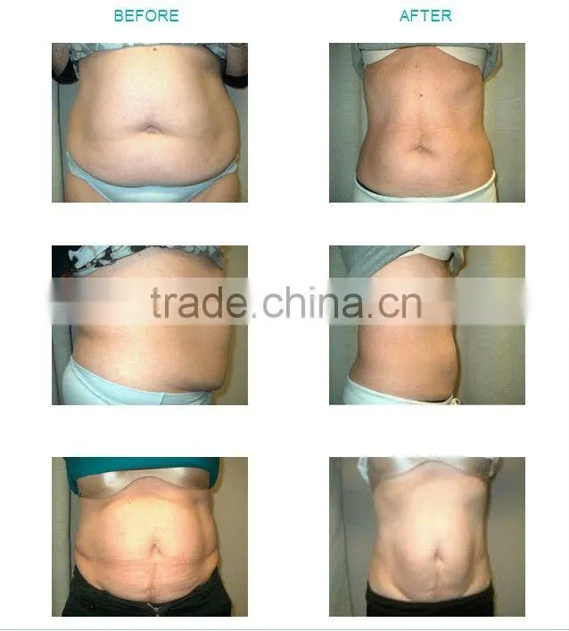 best selling home use cellulite reduction machine