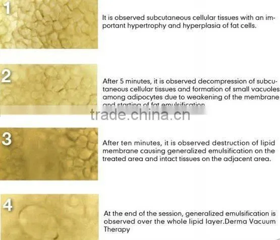 Mini 32 Khz Cavitation & LED RF Beauty Equipment(LipaWay)