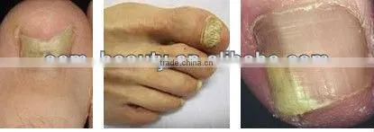 nd yag laser hair removal long pulse laser Skin Rejuvenation equipment