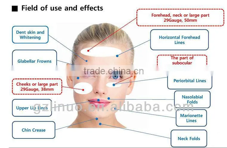 Dynamics of Thread Lifting ,Contour Thread Lift