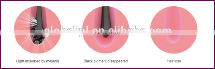 2016 Alibaba China new technology/Permanent/Hair removal/alexandrite hair removal machine