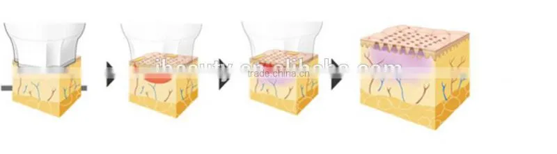 Effective RF Shaper Skin Tightening Machine for Home Use fractional RF