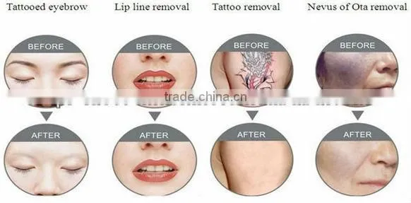 Best nd yag laser tattoo removal with good quality