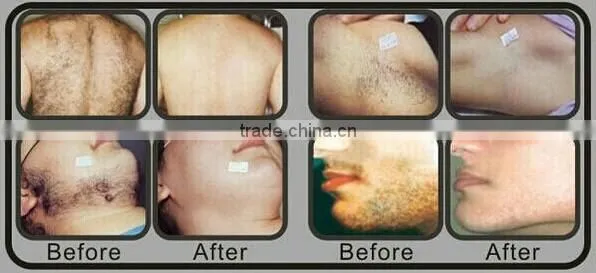 SHR IPL Elight Acne Scar Removal Machine/ Home Permanent Hair Removal