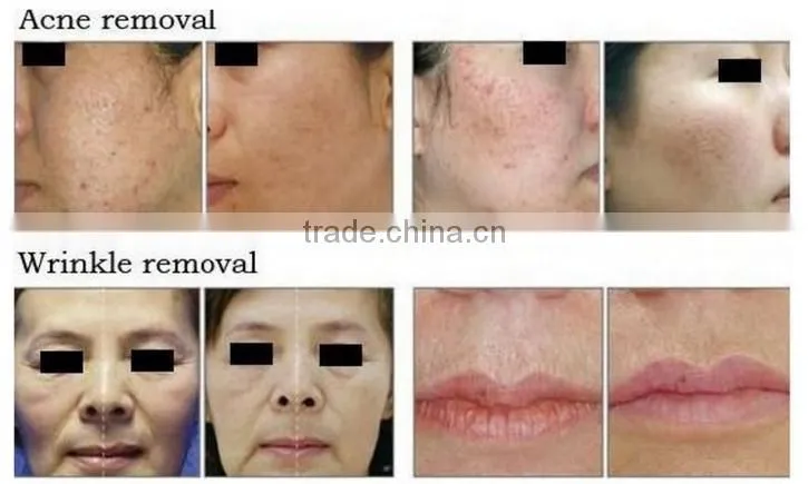 Professional Co2 for Skin Resurfacing Acne Scar Treatment