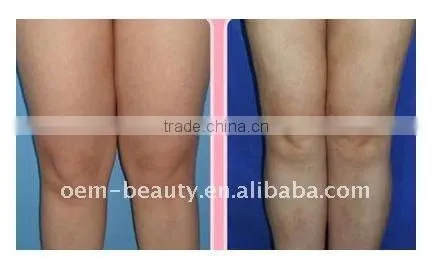 ultrasonic body sculpting cavitation machine F006