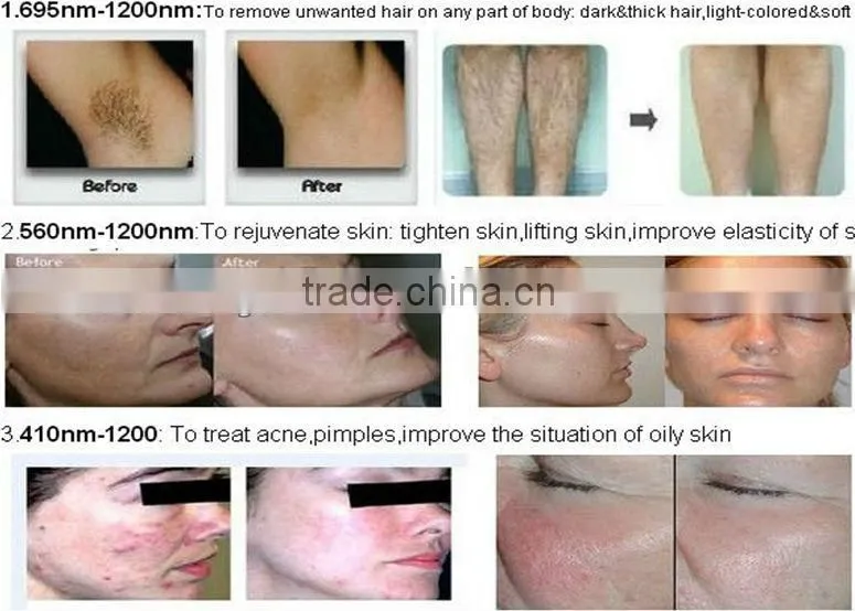 IPL permanent hair reduction