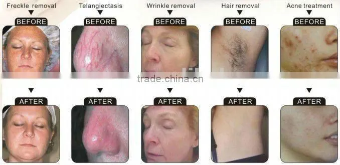 Hot sale suslaser IPL +RF laser ipl hair removal machine