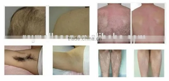 Vertical First Class Technology 808nm Diode Laser Permanent Epilation Machine