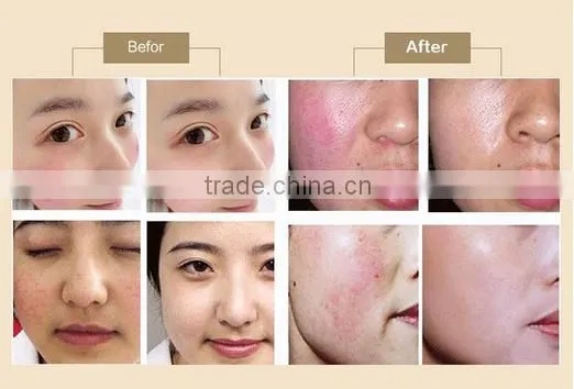 Good effects Wholesale Vascular Remover 980nm Spider Vein Removal Machine