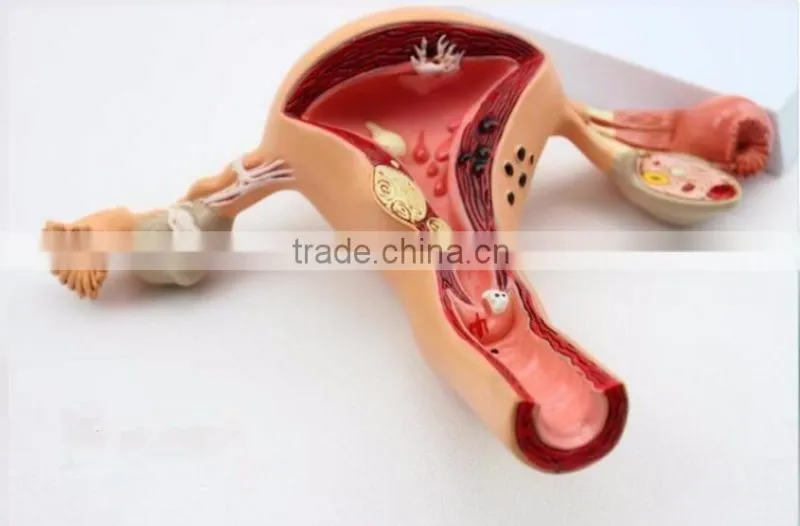 Human uterus and ovary vaginal pathological changes model of reproductive Department of gynecology medical demonstration model
