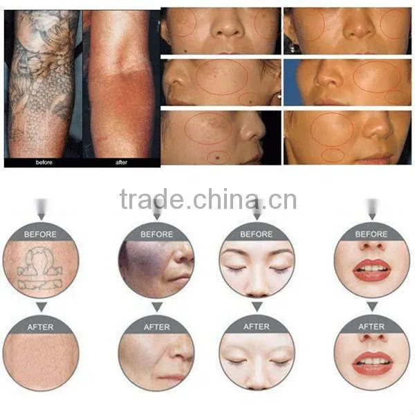 handheld laser hair removal