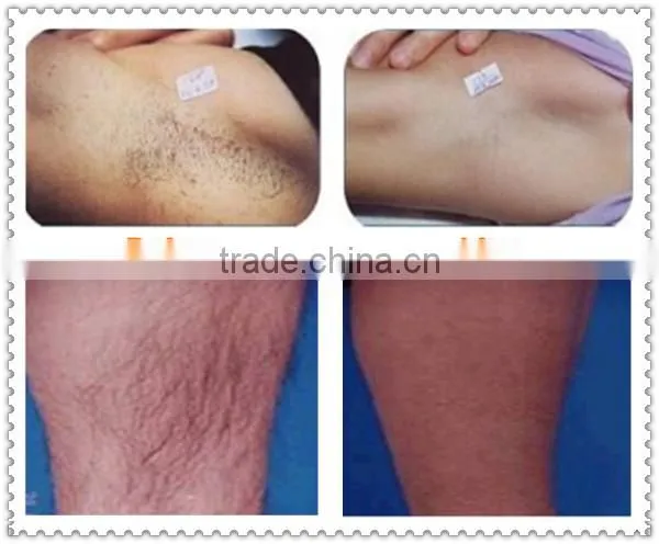 Allfond upper lip hair removal machine