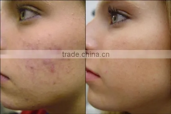 40W China most Professional rf fractional laser co2 burn debridement treatment