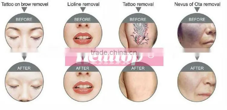 We looking for distributor q-switched nd:yag skin whitening & remove permanent tattoo machine / laser tatto removal machine