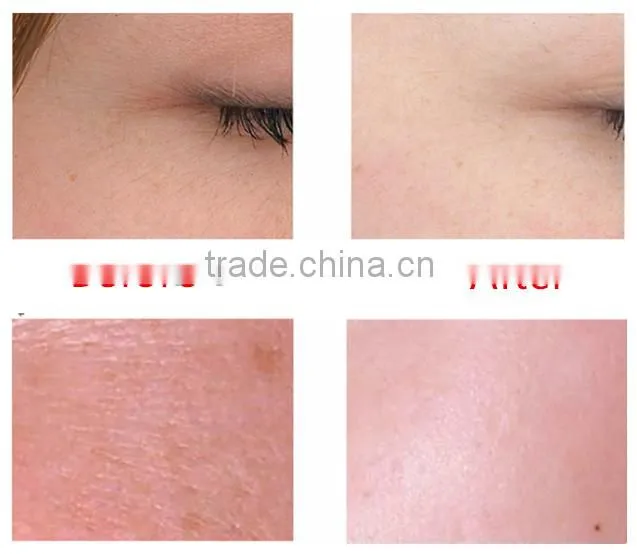 Water Oxygen Jet Peel machine for skin rejuvenation/wrinkle removal with multi function