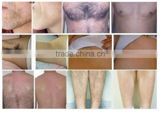 808 diode laser for permanent hair removal
