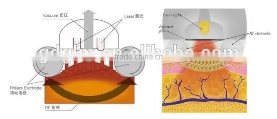 Cavitation+Vacuum+RF+Infrared light+Roller system beauty machine