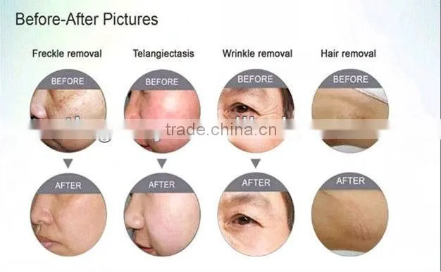 TM-J116 hot sale black doll nd-yag laser