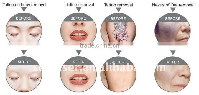 Vertical Q-Switched YAG Laser equipment for Tattoo Removal black head and clean skin