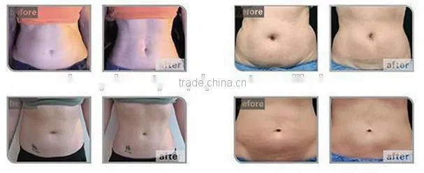 hifu slimming machine price, hifu 13mm fat removal, home hifu machine