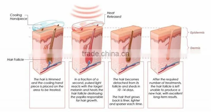Anybeauty Portable 808t-2 808nm didoe laser hair removal machine