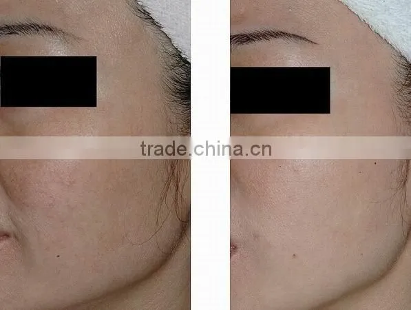 IPL Medical Beauty equipment