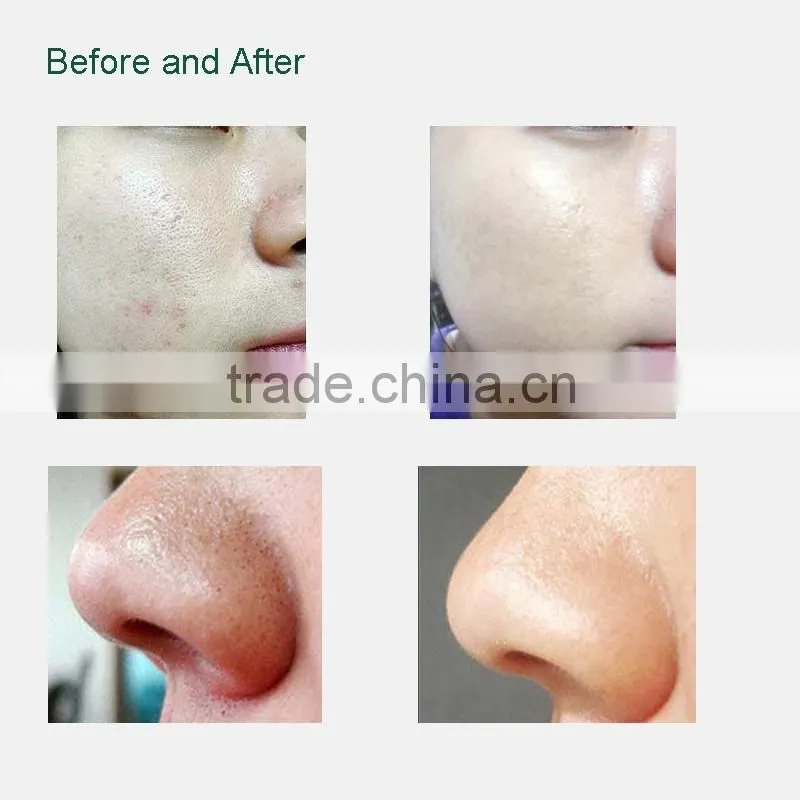 2016 Hot sale!! CE Certificated Micro Dermabrasion Peeling Machine Blackhead Remove Machine for Skin Beauty