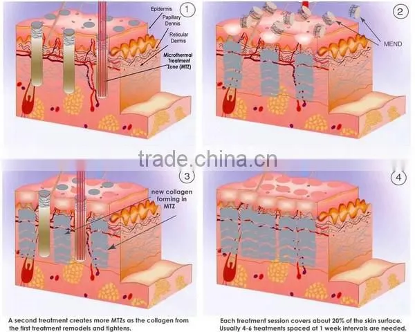 2014 latest laser acne scars REMOVAL non-ablative fractional laser