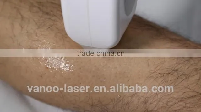 vertical 808nm diode laser hair removal machine