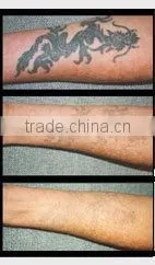 q switch nd yag laser/laser tattoo removal/laser tattoo removal machine medical equipments