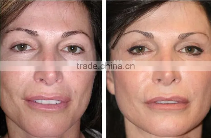 NL-SPA200 Real Factory ! What is dermabrasion ? Dermabrasion cost , reference our SPA200