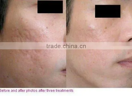 Tank E-light IPL hair removal machine