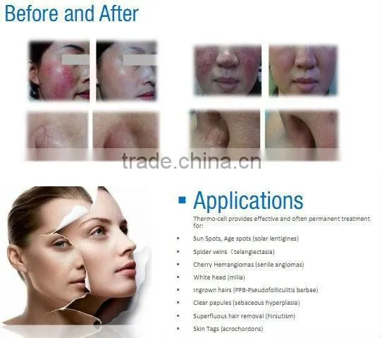 Professional Vascular Removal Machine/30Mhz spider vein removal device /High Frequency vascular removal/ Facial Vein Clearance
