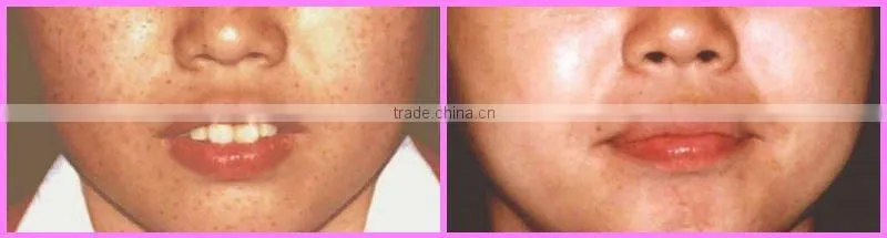 ipl woman facial hair removal