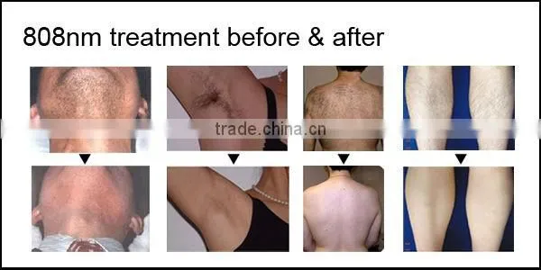 808 nm diode laser