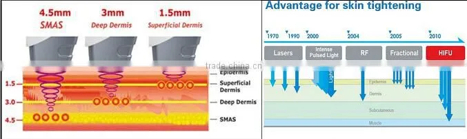 High intensity focused ultrasound anti-aging hifu ultra face lifting machine for spa