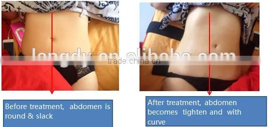 home use 6 in 1 ultrasound cavitation vacuum rf liposuction simming machine for sale