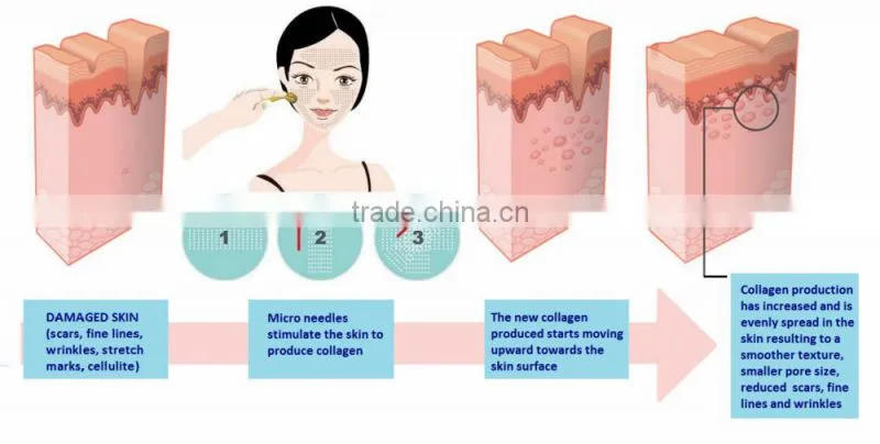 NL-600G ,600S 600needles derma roller acne needles and streched marks removal derma roller