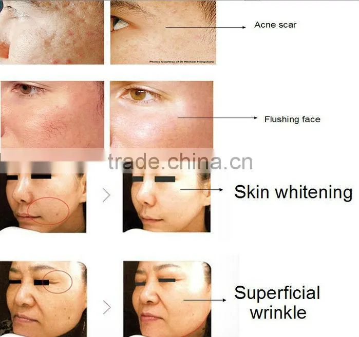 Top performance!!!! microneedle skin treatment portable fractional rf