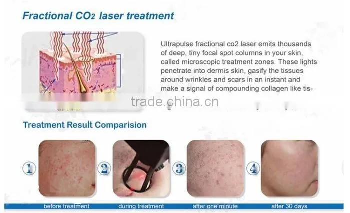Professional Co2 for Skin Resurfacing Acne Scar Treatment