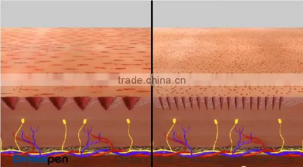 2017 Hot professional electric medical and home use electric auto derma stamp Derma Rolling System NL-EDP04