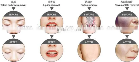 laser tattoo removal machine 1500mj energy laser tattoo removal D003