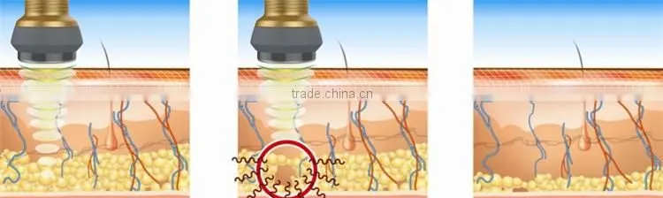 Guangzhou Vacuum Bipolar RF Multipolar RF Skin Tightening Lipo Cavitation Machine Price