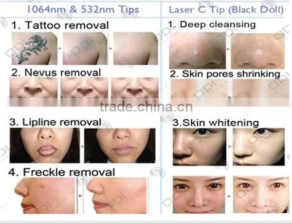 tattoo removal q-switch laser hair removal e light rf ipl machine OD-IRL10 multifunctional home nd yag laser