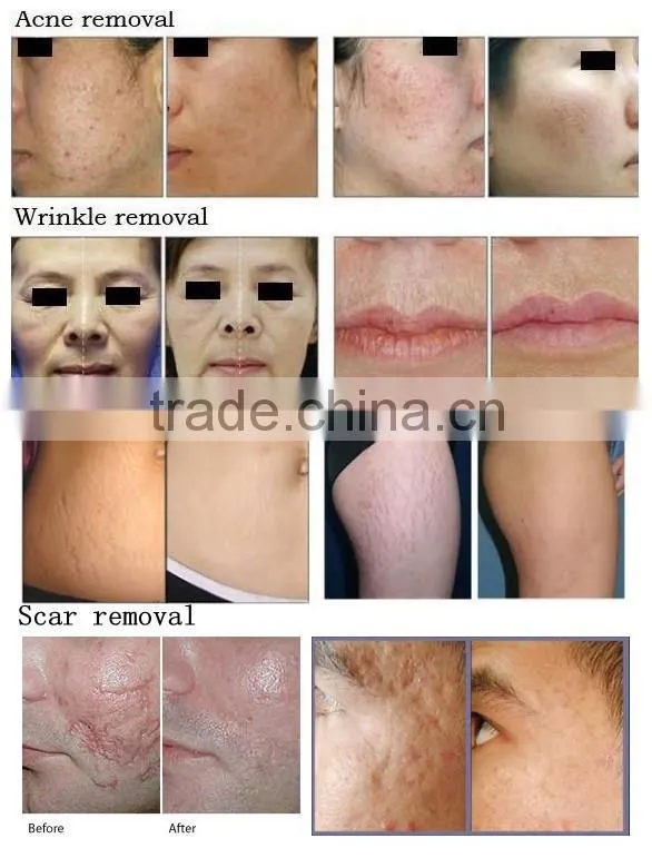 perfect Vaginal tightening fractional co2 laser /co2 fractional laser for scar removal