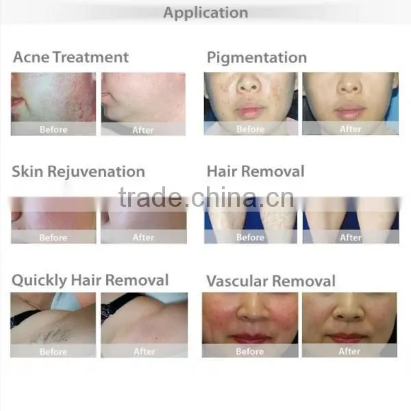 Ipl hair removal new technology product in chin