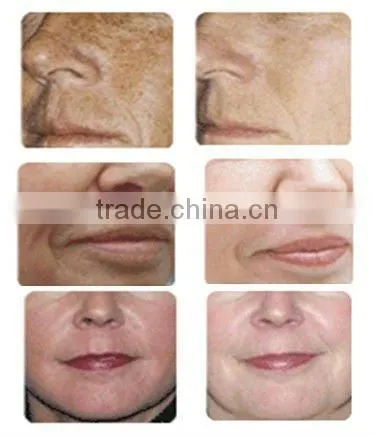 Needle-free Mesotherapy & Oxygen Machine